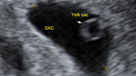 Gestational sac and yolk sac at 6 weeks