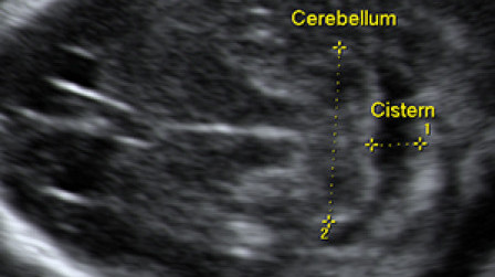 Fetal cerebellum at 17 weeks