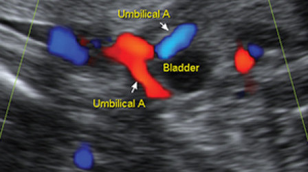 Fetal bladder