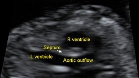 The aortic outflow tract from the fetal heart