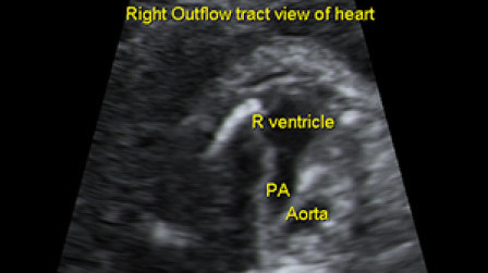The pulmonary outflow tract from the fetal heart