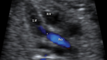 Aortic outflow tract with colour indicating the flow