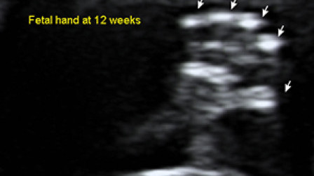Fetal hand at 12 weeks