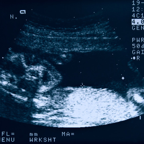Routine Foetal Morphology Scan (18-22 weeks of gestation)