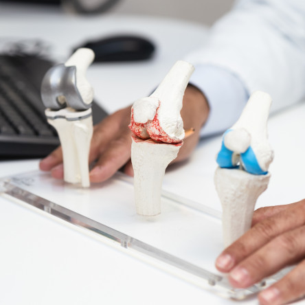 Thumbnail of Robotic Knee Replacement