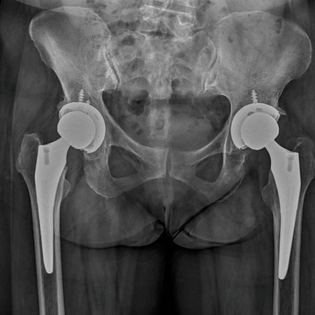 Thumbnail of Total Hip Replacement