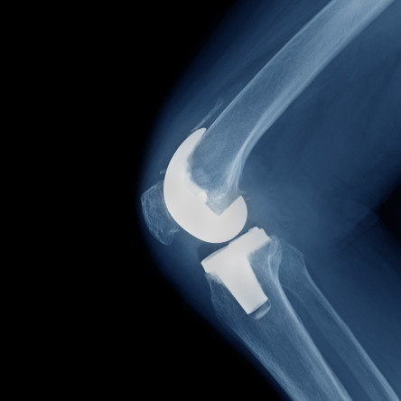 Thumbnail of Total Knee Replacement