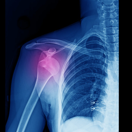 Thumbnail of Shoulder Dislocation