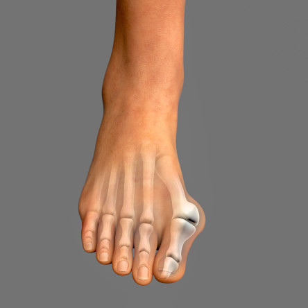 Thumbnail of Hallux Valgus