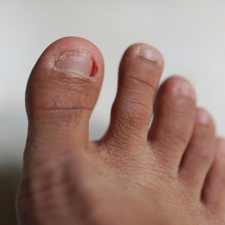 Thumbnail of Ingrown Toenail
