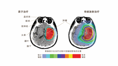 缩图 - 比较质子治疗与传统放射治疗