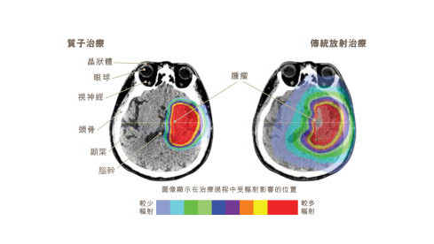 縮圖 - 比較質子治療與傳統放射治療