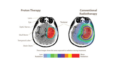 Thumbnail of Proton Therapy vs Conventional Radiotherapy