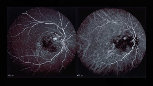 Thumbnail of Fundus Fluorescein Angiogram (FFA) and Indocyanine Green Angiogram (ICGA)