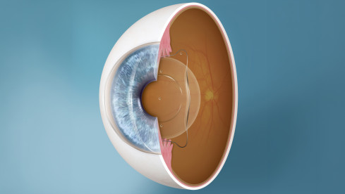 Thumbnail of Refractive Surgeries on Lens