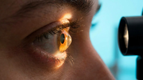 Thumbnail of Refractive Surgeries on Cornea