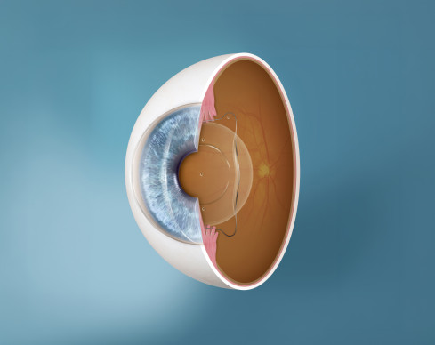 Thumbnail of Implantation of Implantable Contact Lens (ICL)