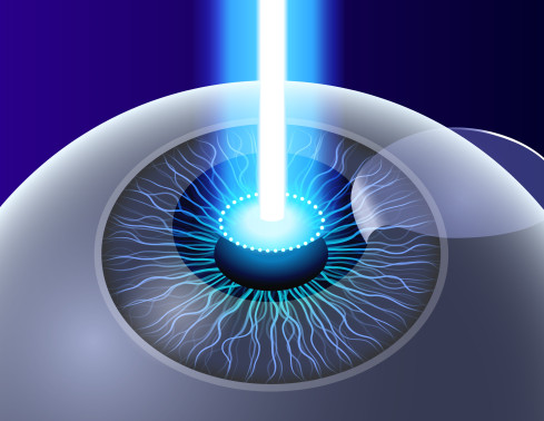 Thumbnail of Laser-assisted In-situ Keratomileusis (LASIK)