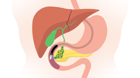 Thumbnail of ERCP (Endoscopic Retrograde Cholangiopancreatography)
