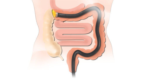Thumbnail of Colonoscopy