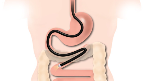 Thumbnail of Small Bowel Endoscopy