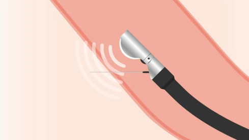 Thumbnail of Endoscopic Ultrasound & Fine Needle Biopsy (EUS-FNB)