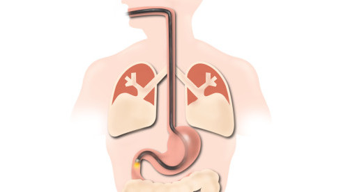 Thumbnail of Gastroscopy (Upper Endoscopy / OGD)