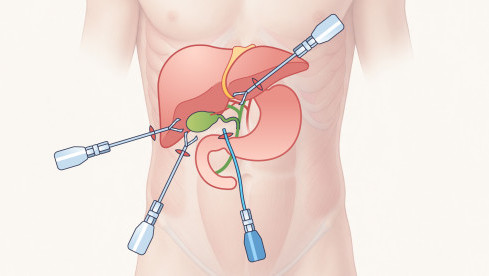 Thumbnail of Laparoscopic Cholecystectomy