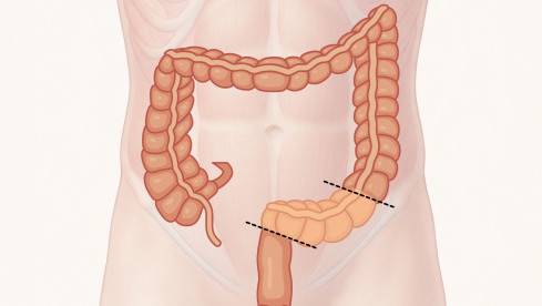 Thumbnail of Laparoscopic Colectomy