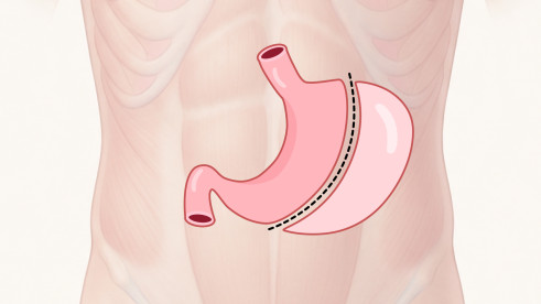 Thumbnail of Laparoscopic Gastrectomy