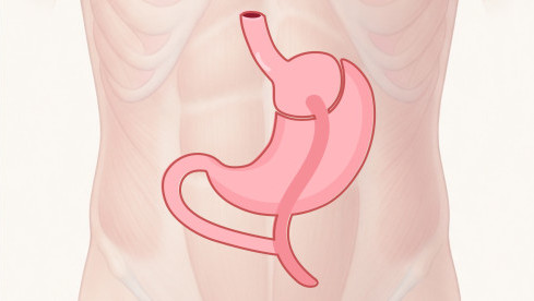 Thumbnail of Obesity Surgery