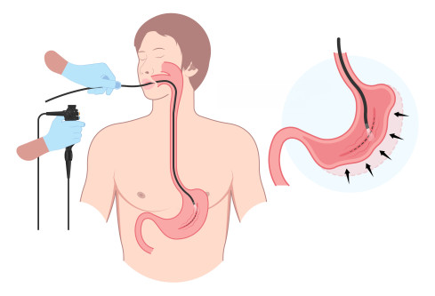 Thumbnail of Endoscopic Weight Reduction Procedures