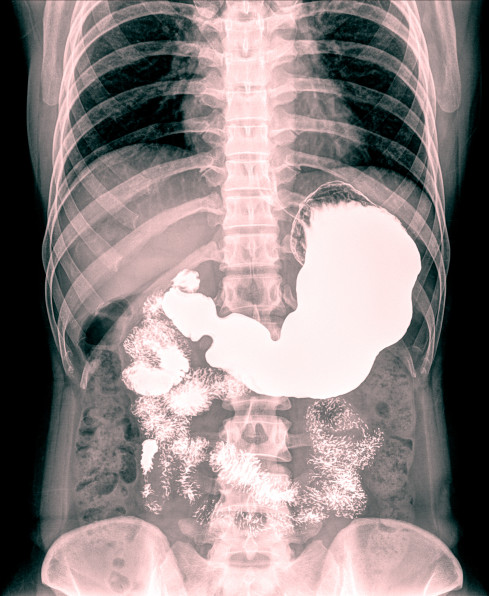 Thumbnail of Upper Gastrointestinal Surgery