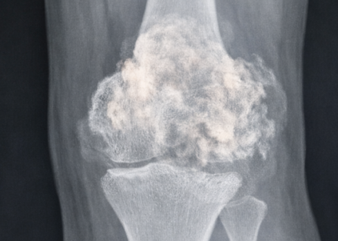 Thumbnail of Tumour and Limb Salvage Surgery