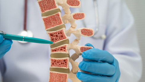 Thumbnail of Osteoporosis
