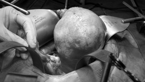 Thumbnail of Tumours