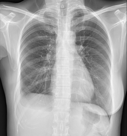 Thumbnail of Pleural Surgery