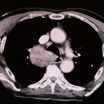 Thumbnail of Mediastinal Surgery