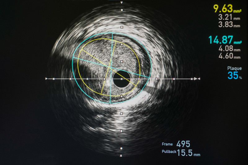 Thumbnail of I-Lab Intravascular Ultrasound System
