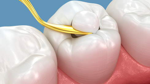 Thumbnail of Filling