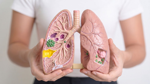 Thumbnail of Lung