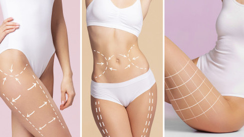 Thumbnail of Body Contouring Surgery