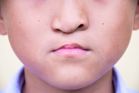 Thumbnail of Congenital Defect Reconstruction