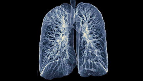 Thumbnail of Lung Cancer