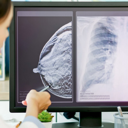 Thumbnail of Breast Screening Programme