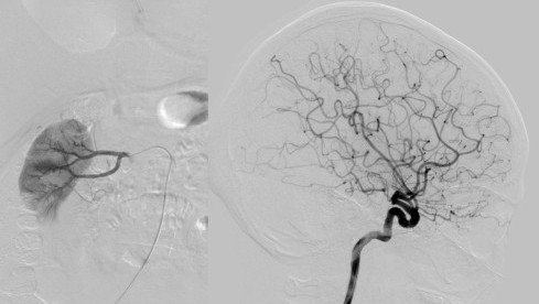 Thumbnail of Arteriography