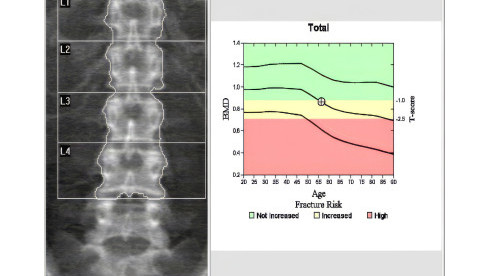 Thumbnail of Dexa Bone Densitometry
