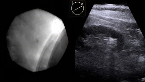 Thumbnail of Lithotripsy
