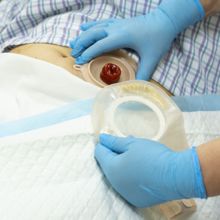 Thumbnail of Ostomy Care