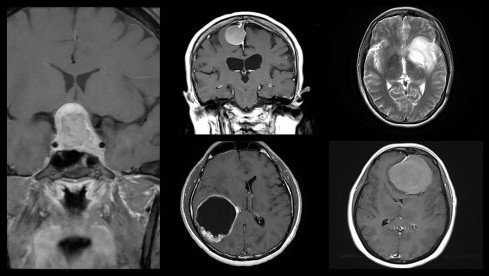 Thumbnail of Brain Tumour Service